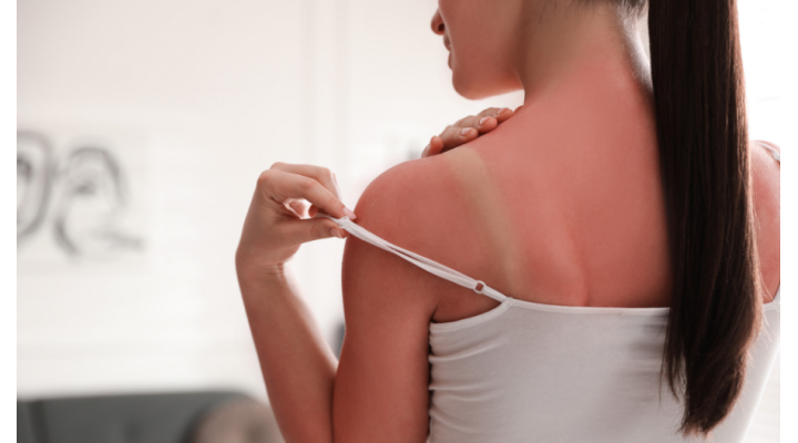 Eritema solare: consigli per prevenirlo e attenuarlo