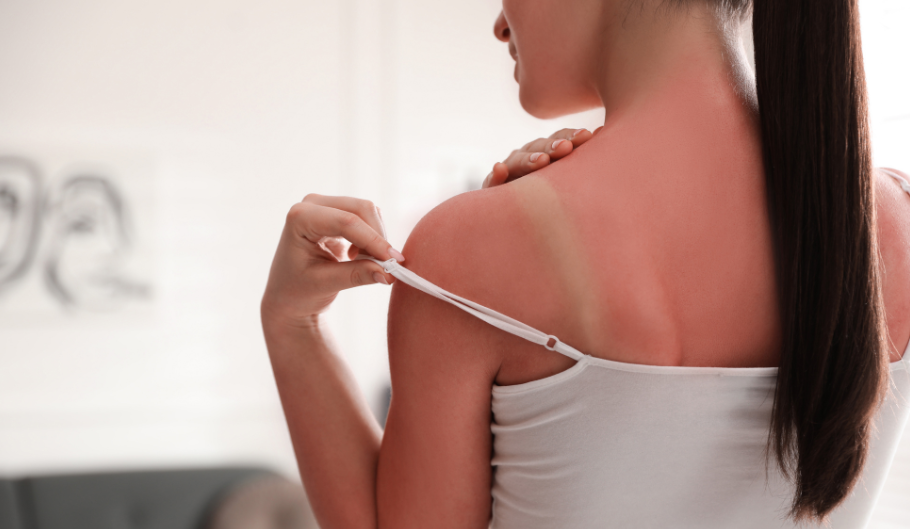 Eritema solare: consigli per prevenirlo e attenuarlo Eritema solare: consigli per prevenirlo e attenuarlo