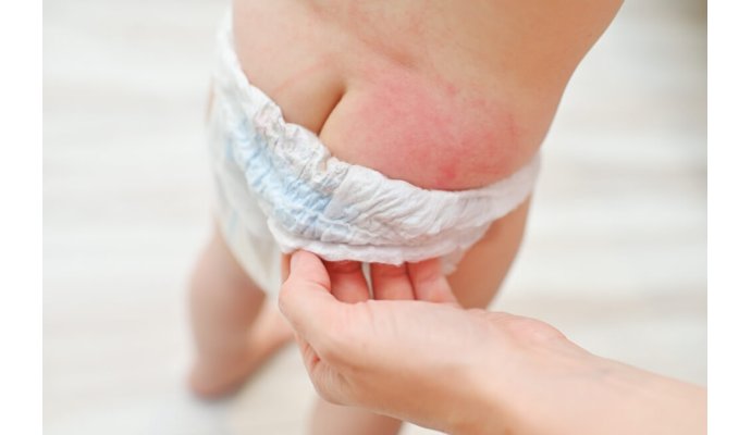 Dermatite da pannolino? Ecco come evitarla o curarla