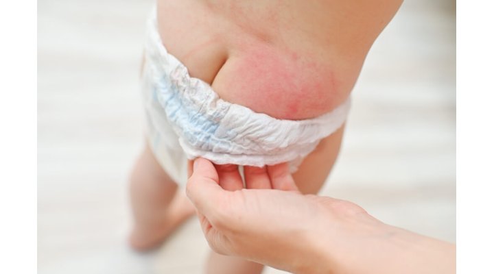 Dermatite da pannolino? Ecco come evitarla o curarla Dermatite da pannolino? Ecco come evitarla o curarla