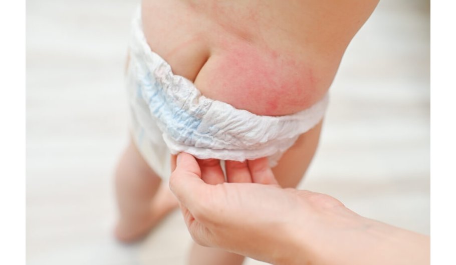 Dermatite da pannolino? Ecco come evitarla o curarla