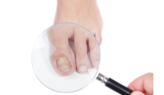 Onicomicosi, cos'è e come trattare il fungo delle unghie